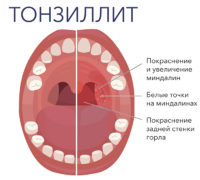 Тонзиллит у ребенка (психосоматика)