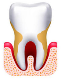 Пародонтоз – разрушение околозубных тканей