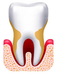 Пародонтоз